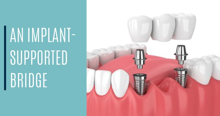 Best Dental implant in Ramanathapuram